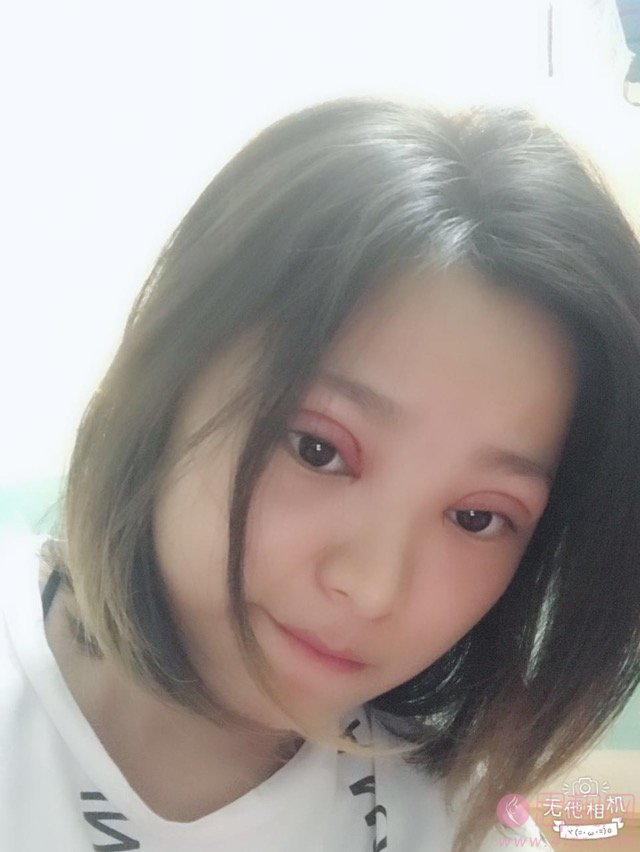 上海九院林明做双眼皮怎么样？附案例分享+2021年价格表公布