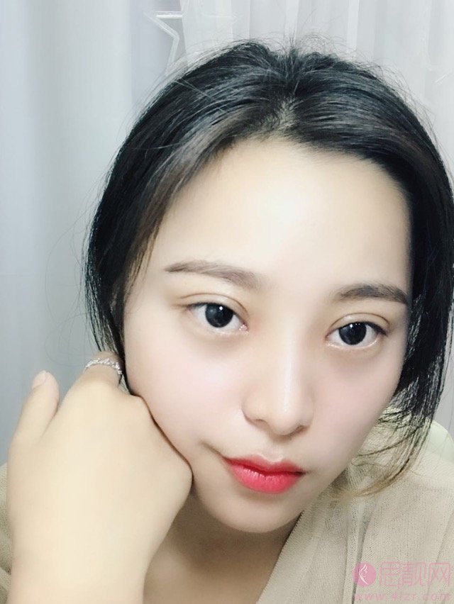 上海九院林明做双眼皮怎么样？附案例分享+2021年价格表公布