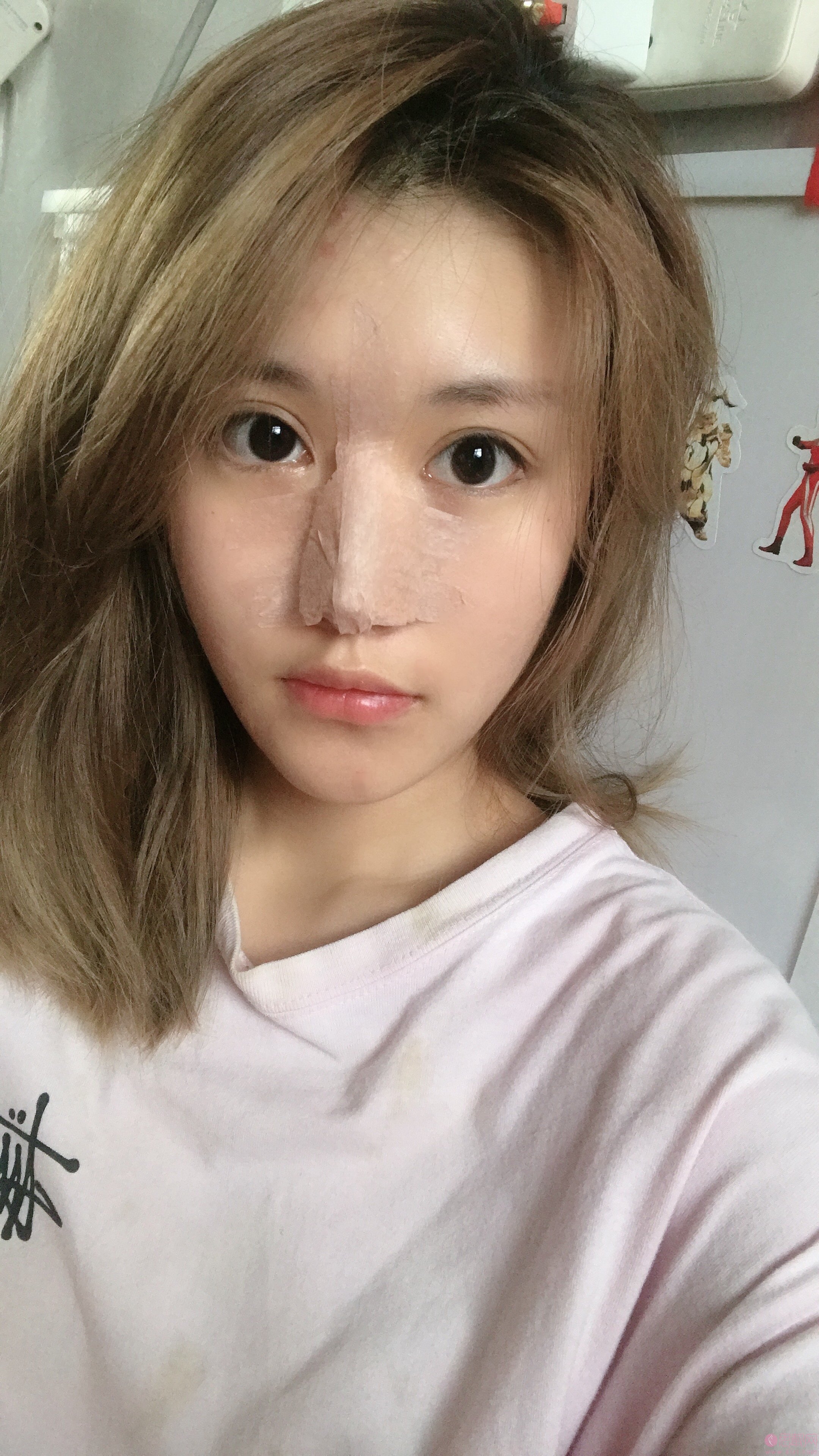 镇江润州采薇医疗美容隆鼻怎么样？附案例及2021年价格表公开