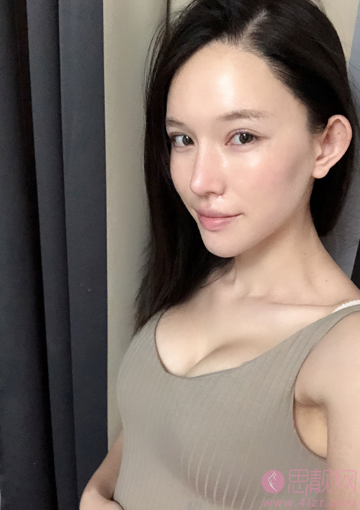 南京华美美容医院假体隆胸案例+2021年价格表公布