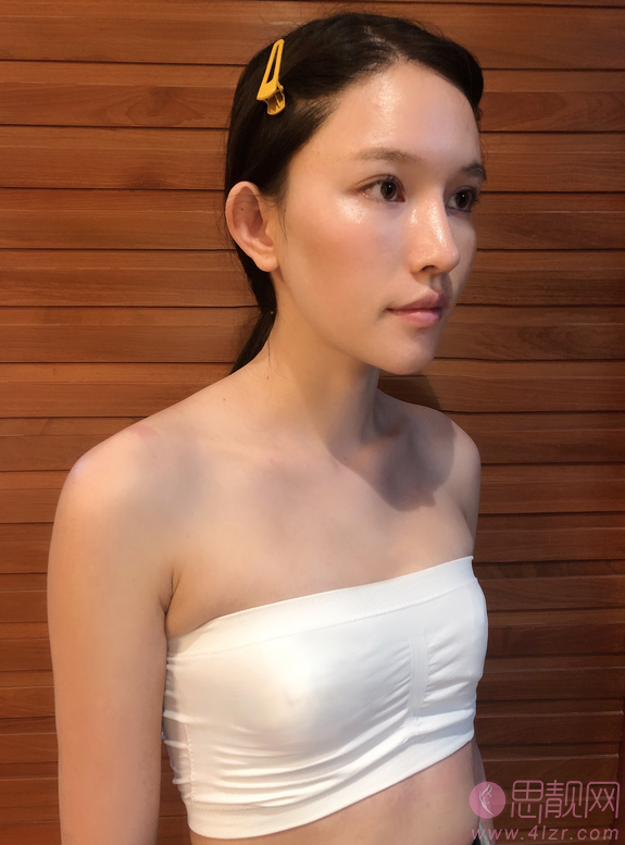 南京华美美容医院假体隆胸案例+2021年价格表公布