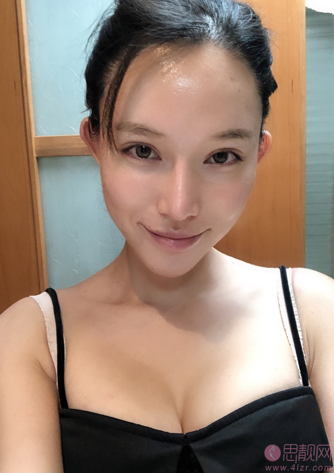 南京华美美容医院假体隆胸案例+2021年价格表公布