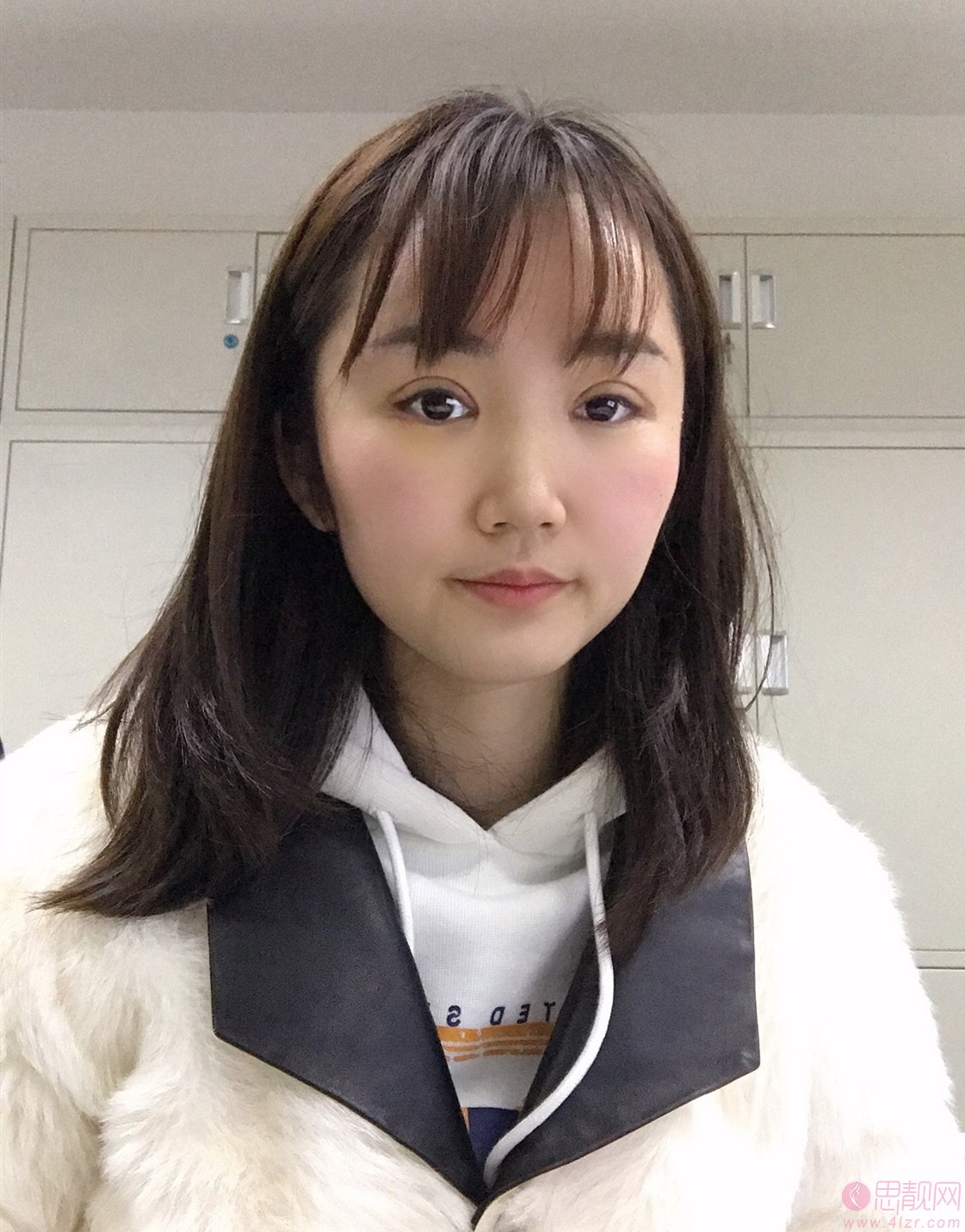 南昌一附院文辉才主任全切双眼皮案例分享+2021年价格表曝光