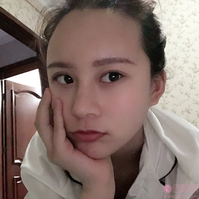成都玉之光黄开亮隆鼻前后案例对比+2021年价格表曝光