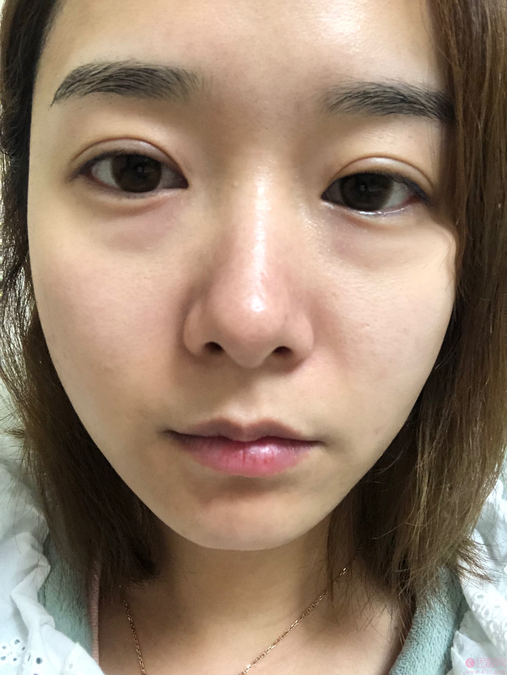 杭州健丽医美做眼袋怎么样？附真人案例一览及2021年价格表曝光