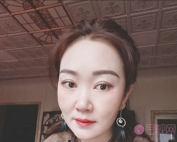 珠江医院整形科陈兵做双眼皮如何？附术后效果反馈+2021年价格表发布