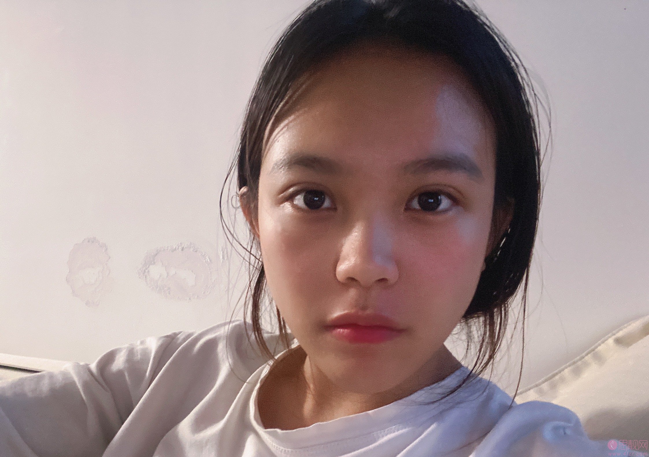 洛阳王静割双眼皮多少钱？附价格表及双眼皮案例一览