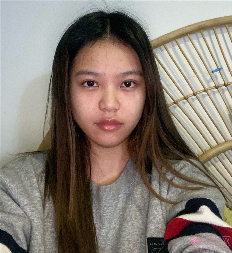 洛阳王静割双眼皮多少钱？附价格表及双眼皮案例一览