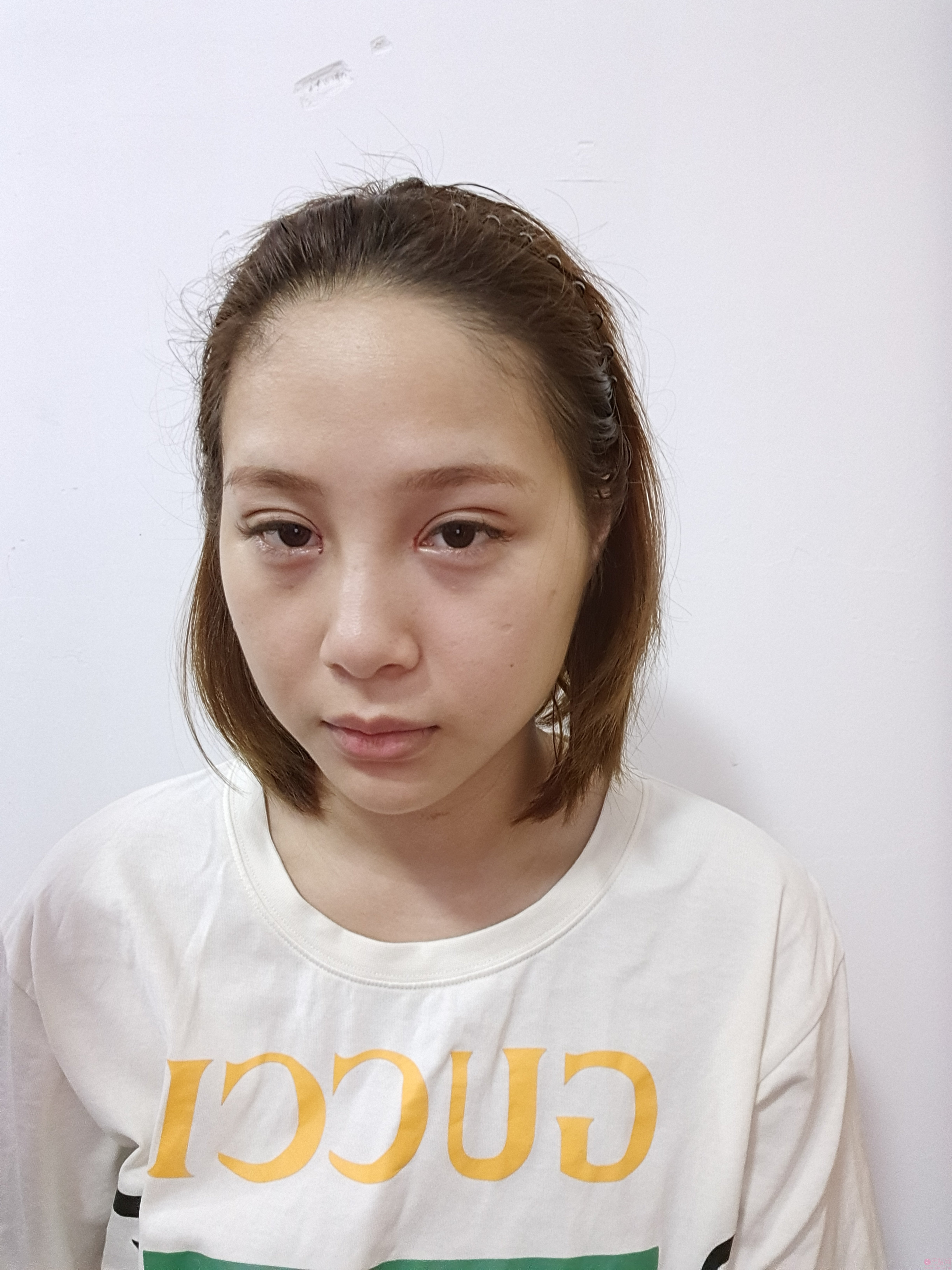 徐州美特莱斯做双眼皮好不好？附双眼皮案例及2021年价格表曝光