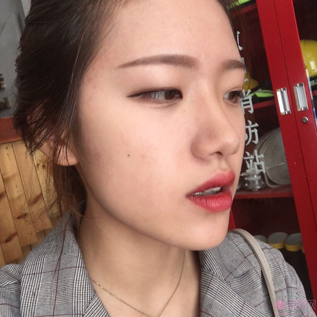 上海第九人民医院激光美容科？收费表一览+激光祛痘真人案例分享