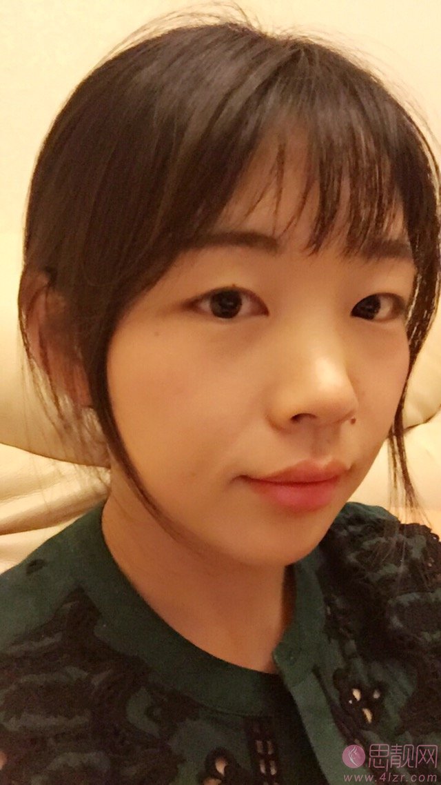 哈医大美容科郝立君做双眼皮怎么样？附双眼皮前后效果对比及价格表明细一览