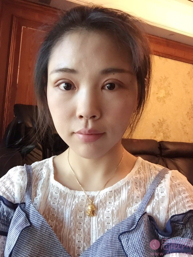 哈医大美容科郝立君做双眼皮怎么样？附双眼皮前后效果对比及价格表明细一览