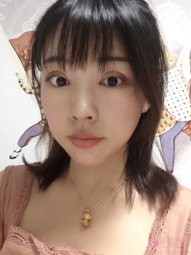 哈医大美容科郝立君做双眼皮怎么样？附双眼皮前后效果对比及价格表明细一览