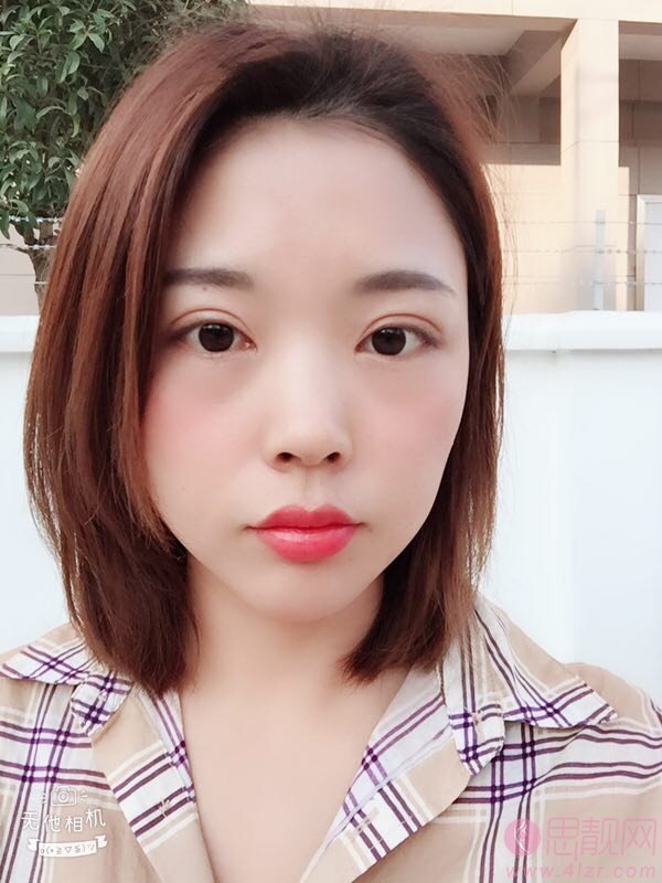 哈医大美容科郝立君做双眼皮怎么样？附双眼皮前后效果对比及价格表明细一览