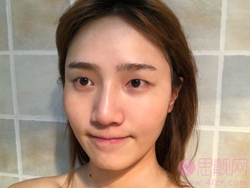 深圳福华医疗美容医院王志东做双眼皮怎么样？附案例及2021年价格表一览