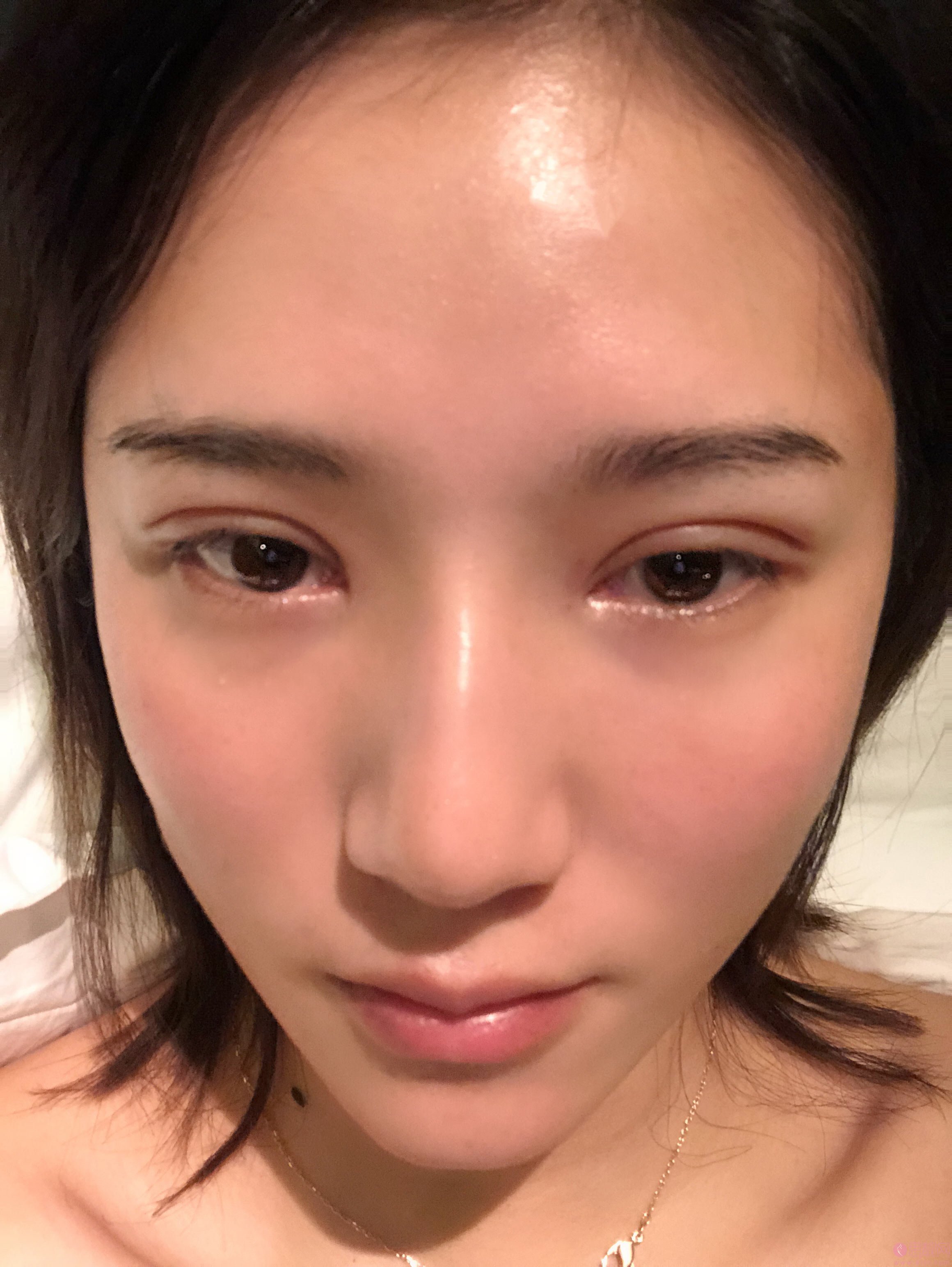 深圳福华医疗美容医院王志东做双眼皮怎么样？附案例及2021年价格表一览