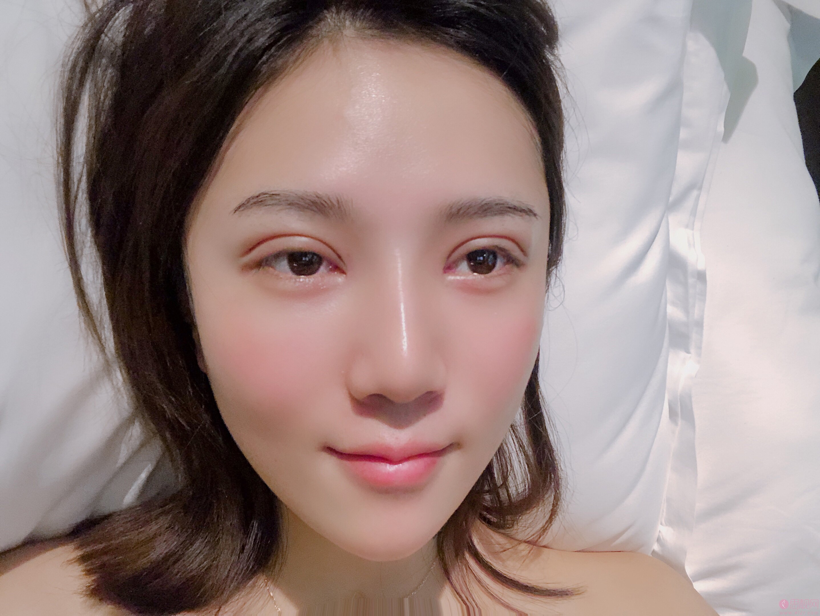 深圳福华医疗美容医院王志东做双眼皮怎么样？附案例及2021年价格表一览