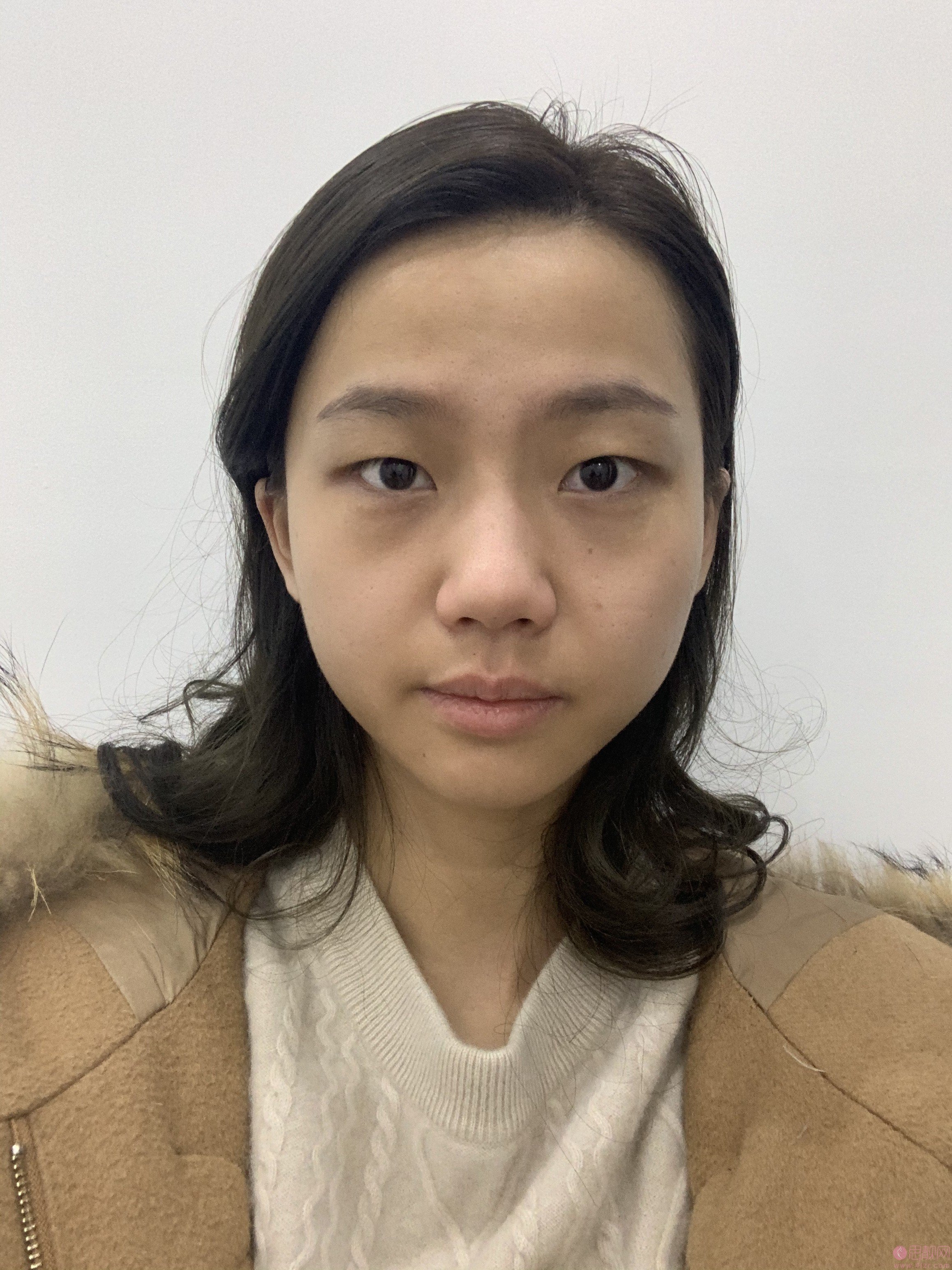 薇琳张怀军做双眼皮怎么样2021年价格表发布+双眼皮案例分享