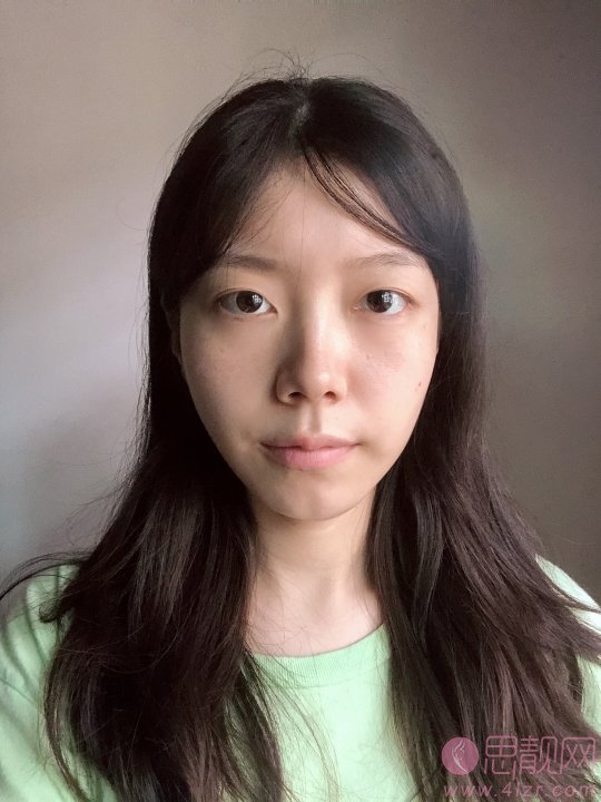 珠江医院整形科陈兵做双眼皮如何？附案例及价格表明细一览