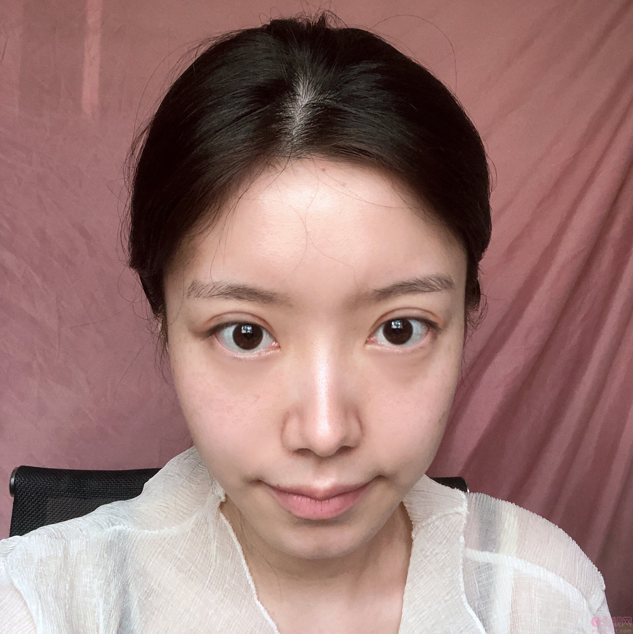 珠江医院整形科陈兵做双眼皮如何？附案例及价格表明细一览