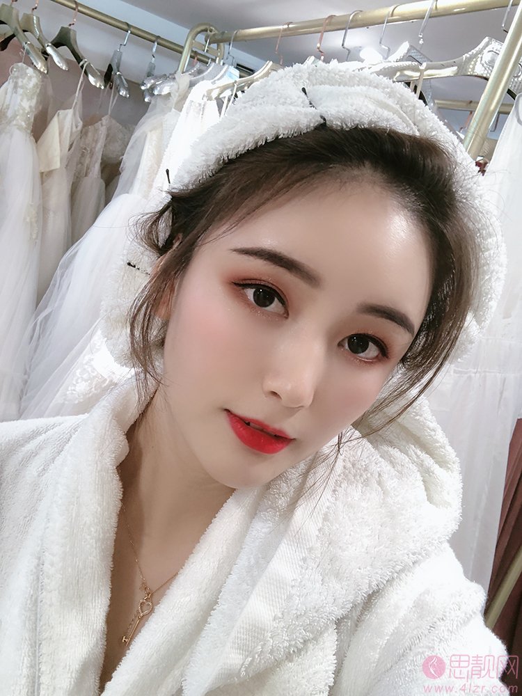 紫馨医疗美容医院梁进华医生自体脂肪填充怎么样?术后效果展示+2021年价格表公开