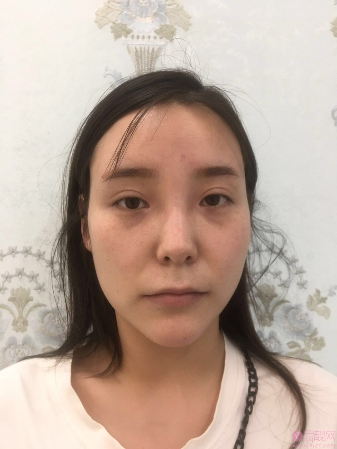鲁树荣医生脂肪填充怎么样？附案例及价格表一览