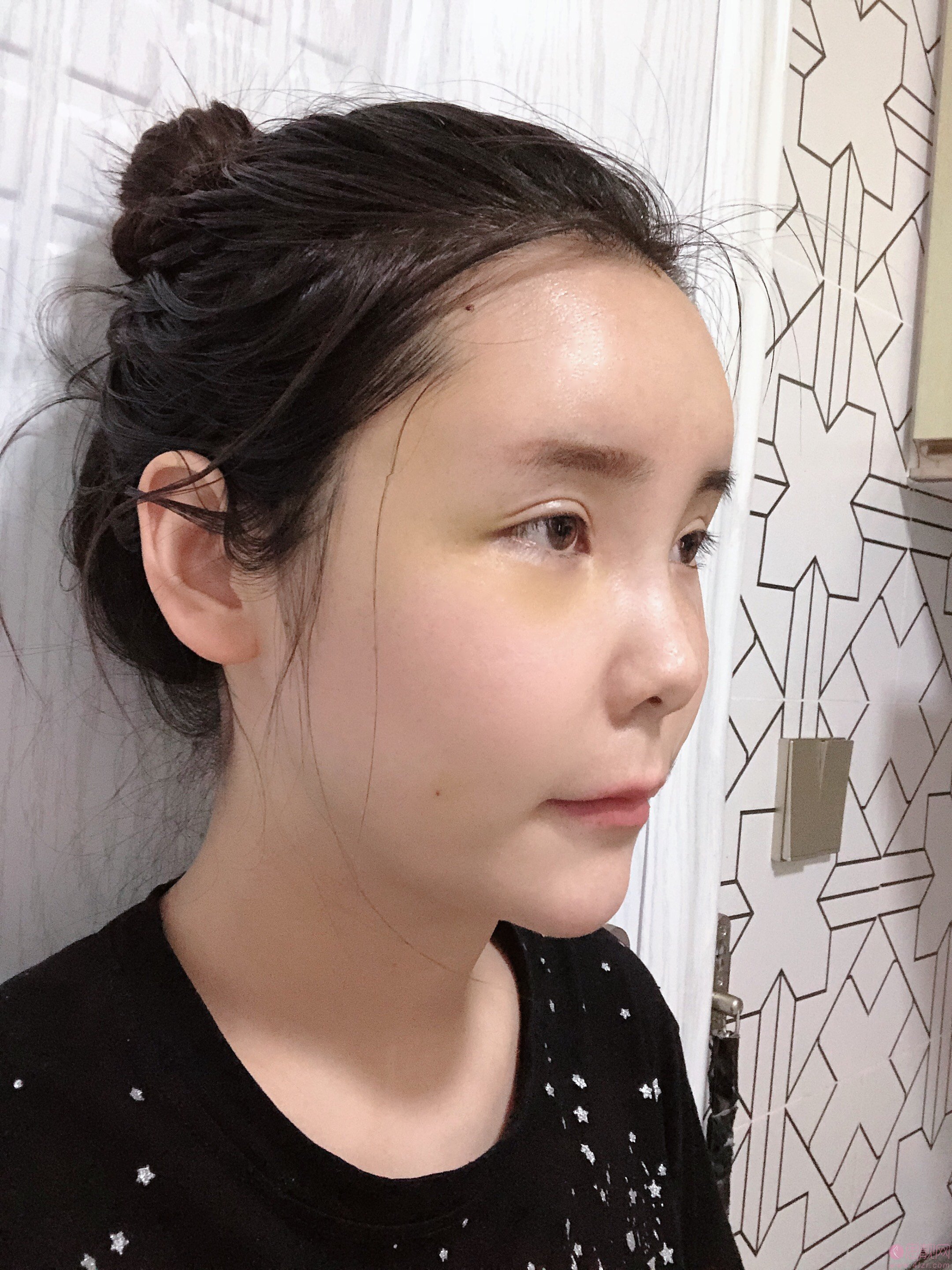 鲁树荣医生脂肪填充怎么样？附案例及价格表一览