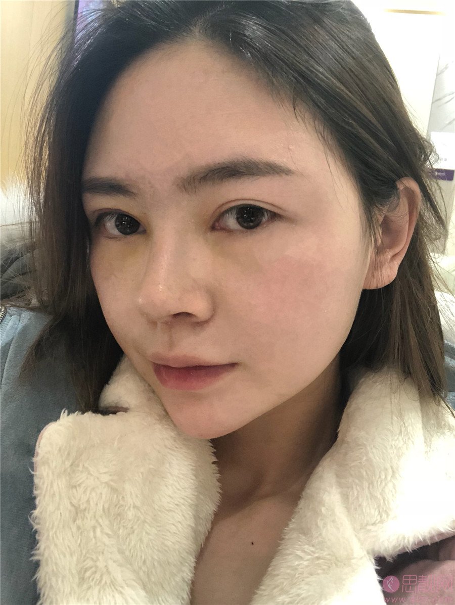 重庆华美整形美容医院怎么样?2021年价格表发布+鼻修复案例分享