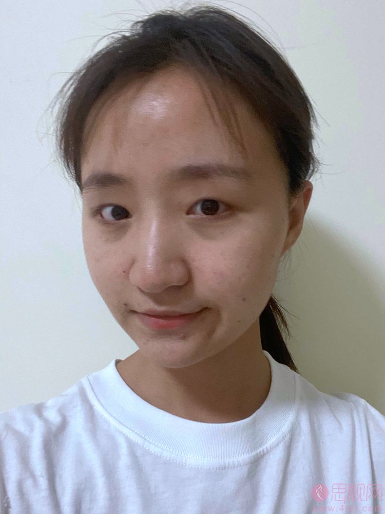 沈阳军区总院做双眼皮多少钱?附双眼皮真人案例展示