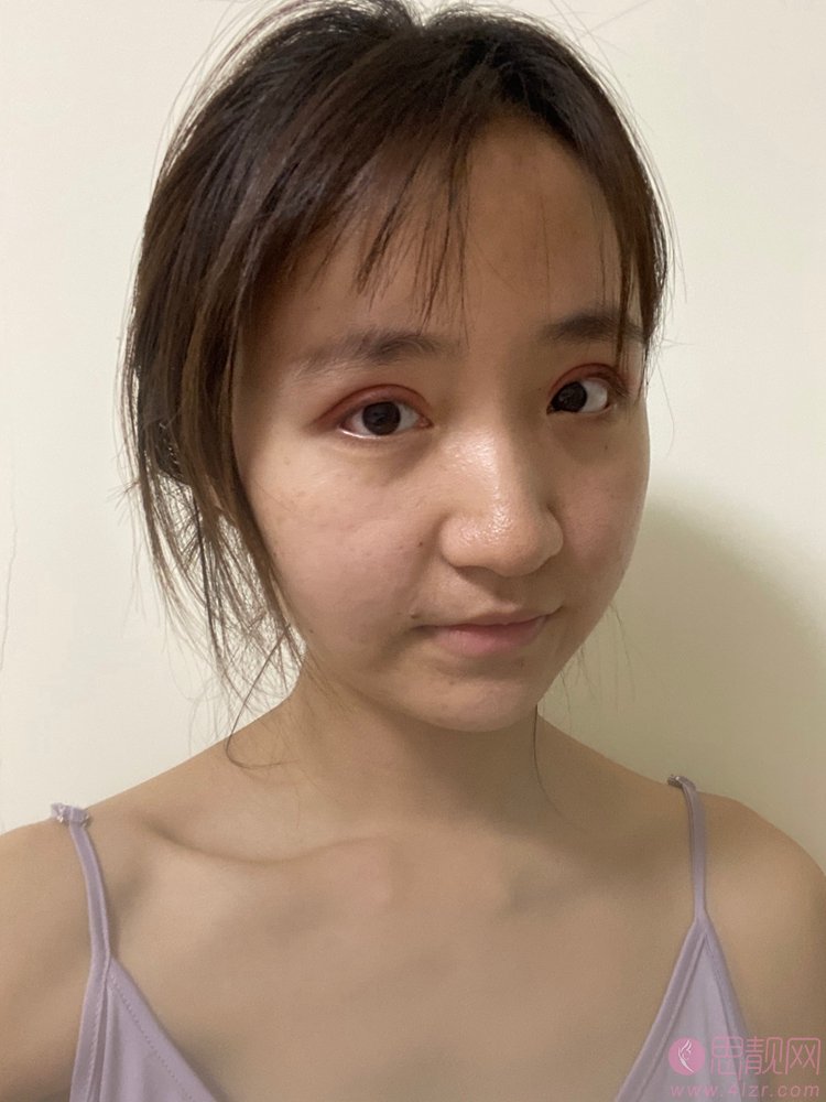 沈阳军区总院做双眼皮多少钱?附双眼皮真人案例展示