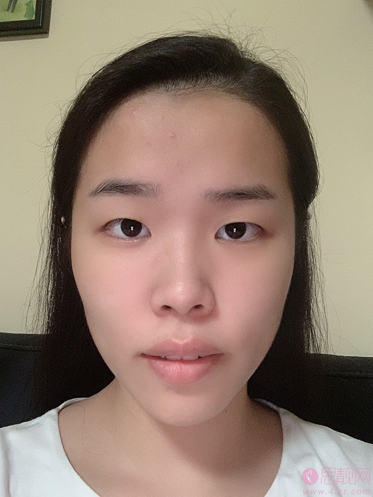 北京京美谢海波医生做双眼皮怎么样？附真人案例反馈+2021年价格表公开