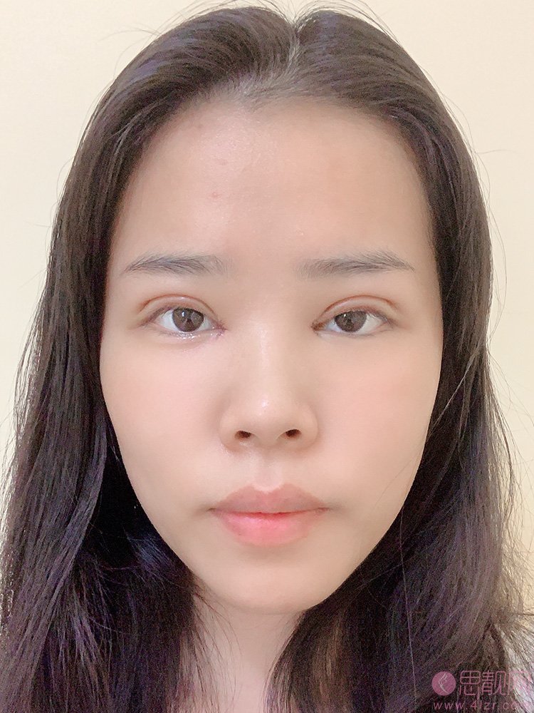 北京京美谢海波医生做双眼皮怎么样？附真人案例反馈+2021年价格表公开