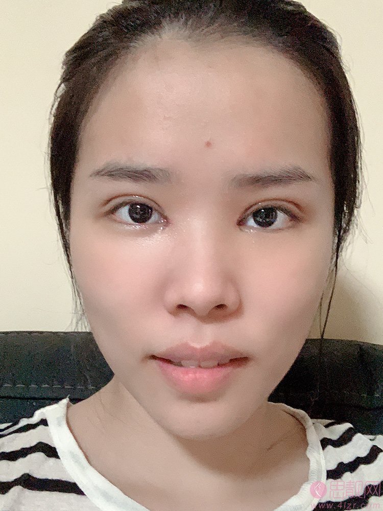 北京京美谢海波医生做双眼皮怎么样？附真人案例反馈+2021年价格表公开