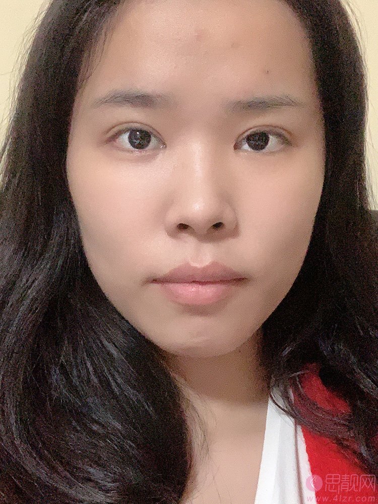 北京京美谢海波医生做双眼皮怎么样？附真人案例反馈+2021年价格表公开