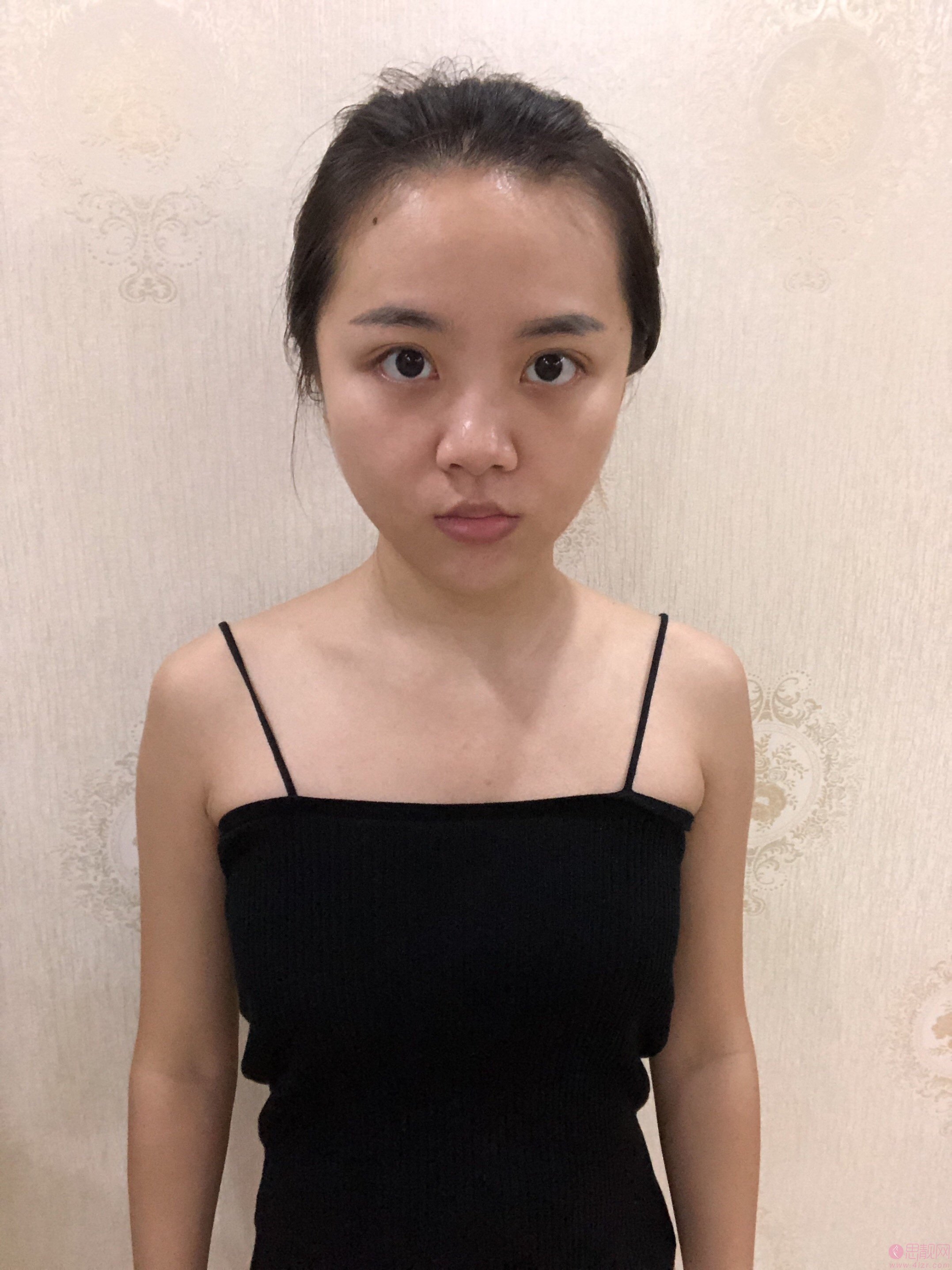 长沙亚韩医疗美容医院段春巍隆鼻术后案例反馈+2021年价格表发布