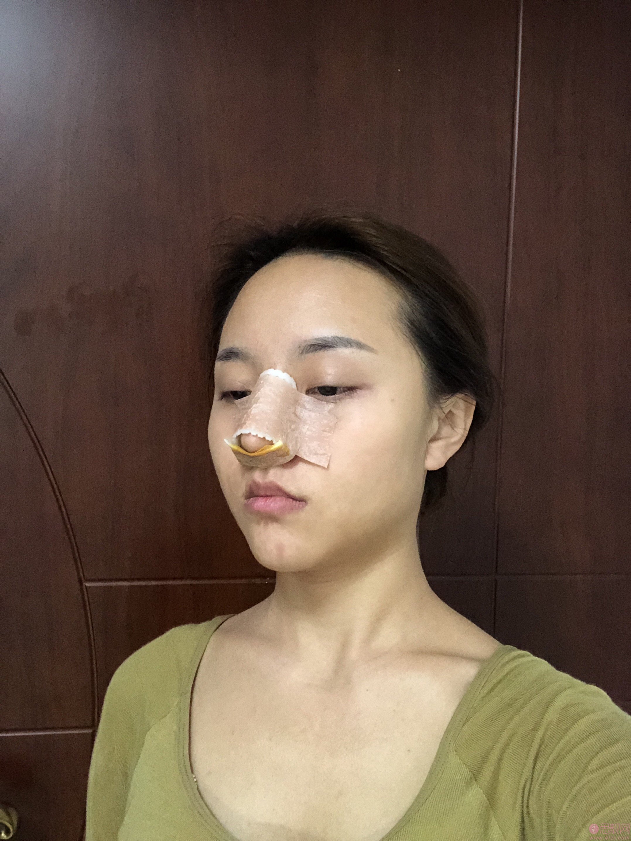 长沙亚韩医疗美容医院段春巍隆鼻术后案例反馈+2021年价格表发布
