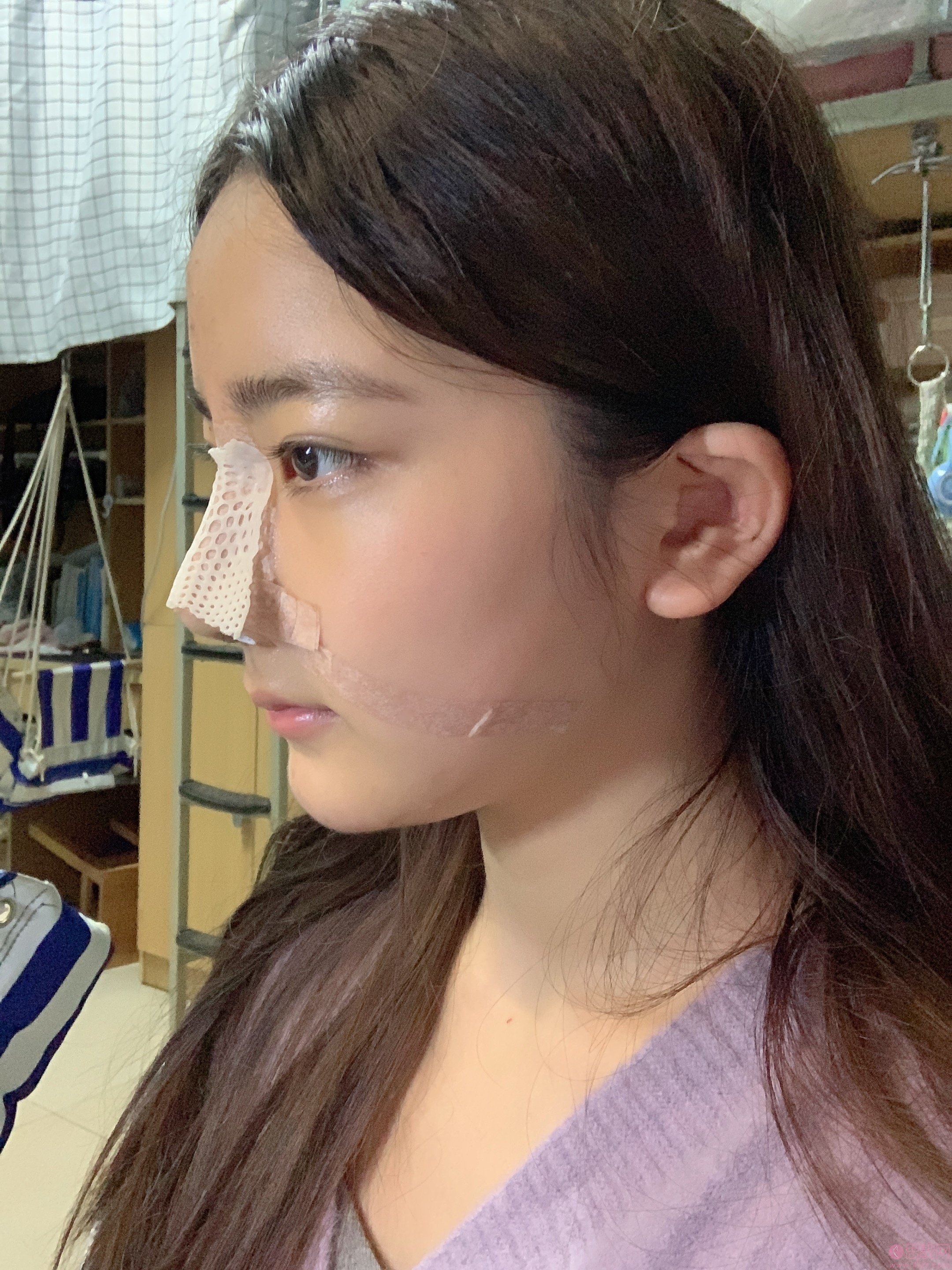 第三军医大学附属重庆西南医院毕胜医生隆鼻多少钱？2021年价格表一览+案例分享
