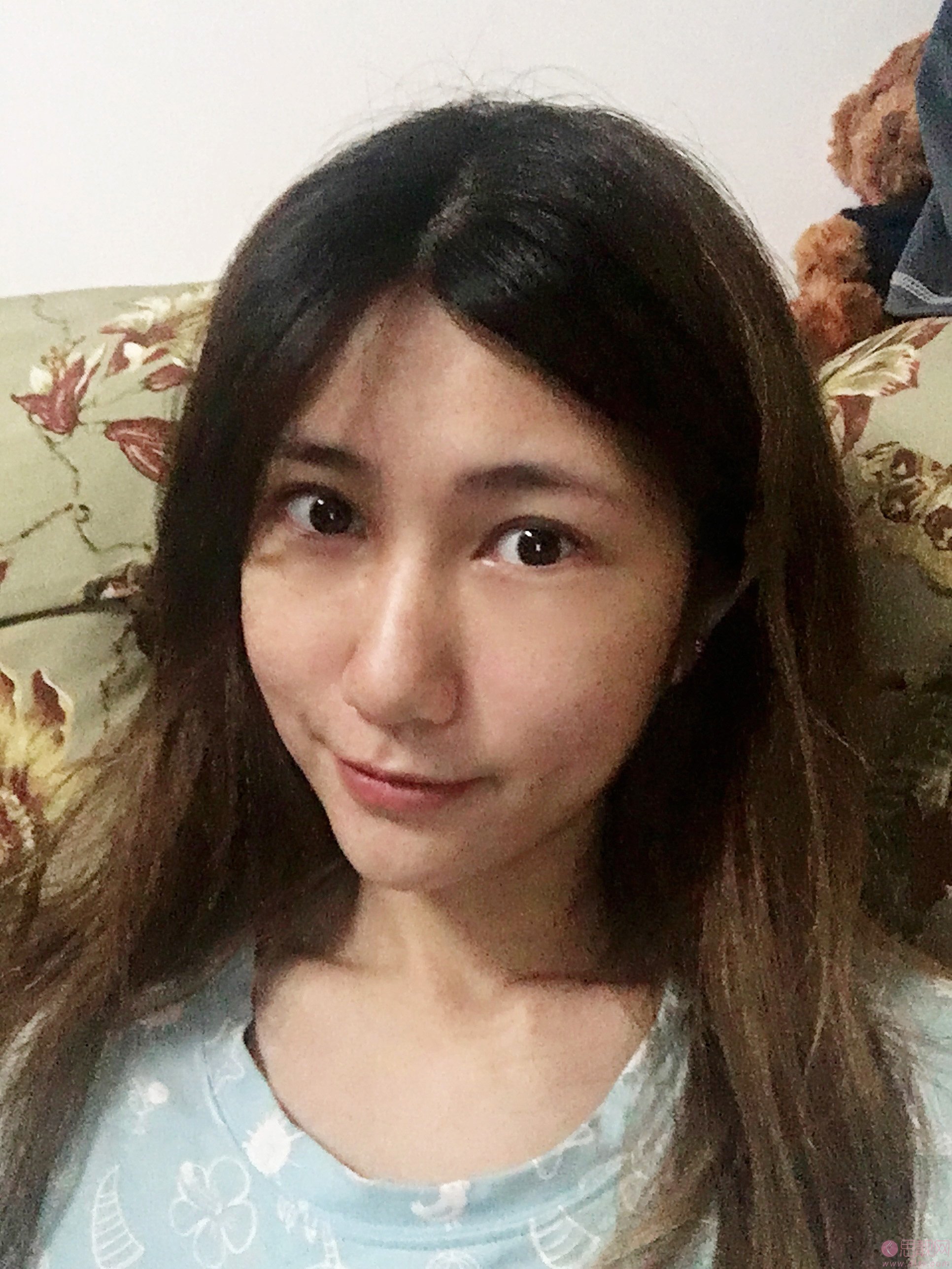 果酸换肤治疗痘坑效果怎么样？术前术后真人案例对比效果展示