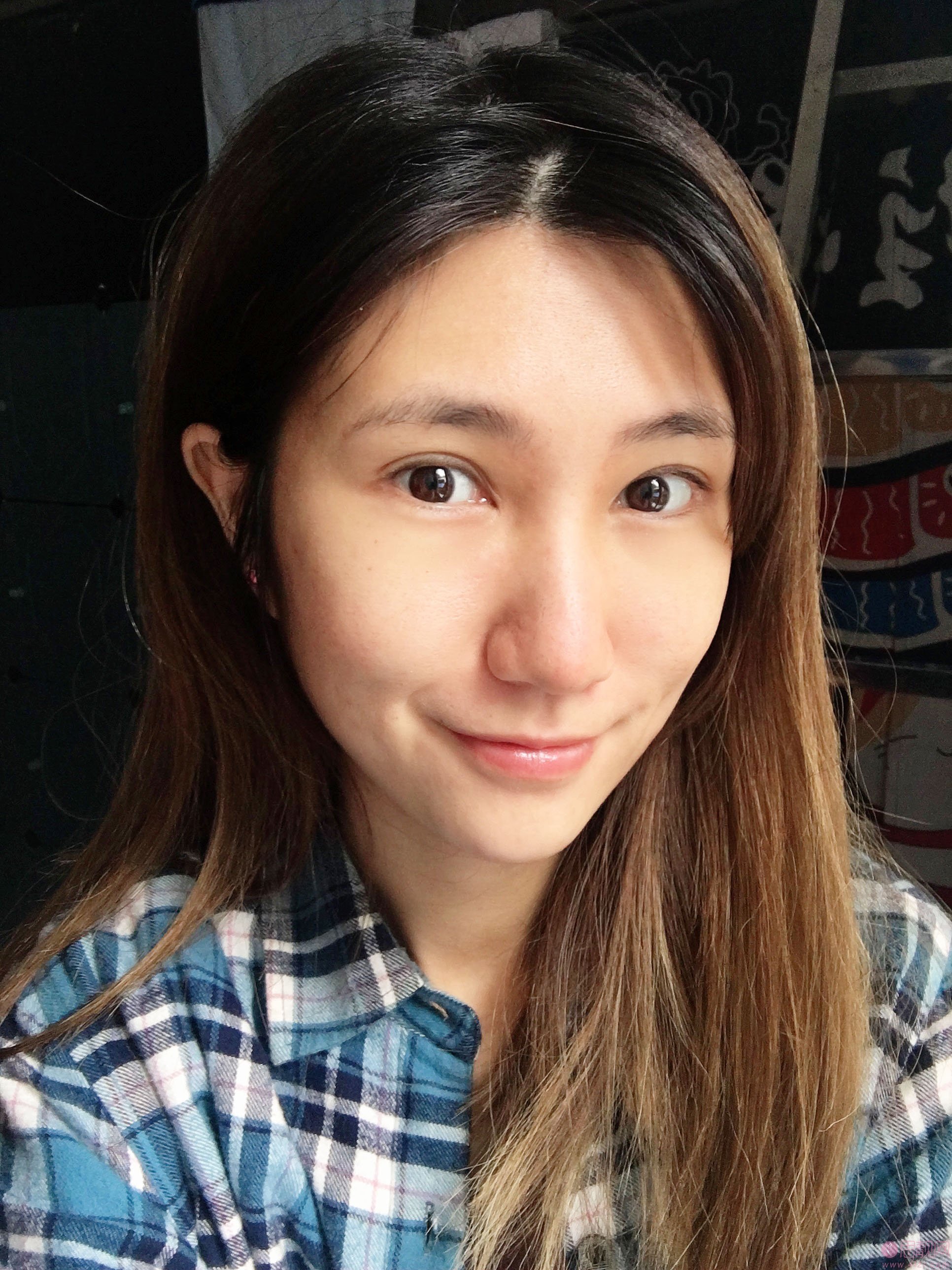 果酸换肤治疗痘坑效果怎么样？术前术后真人案例对比效果展示