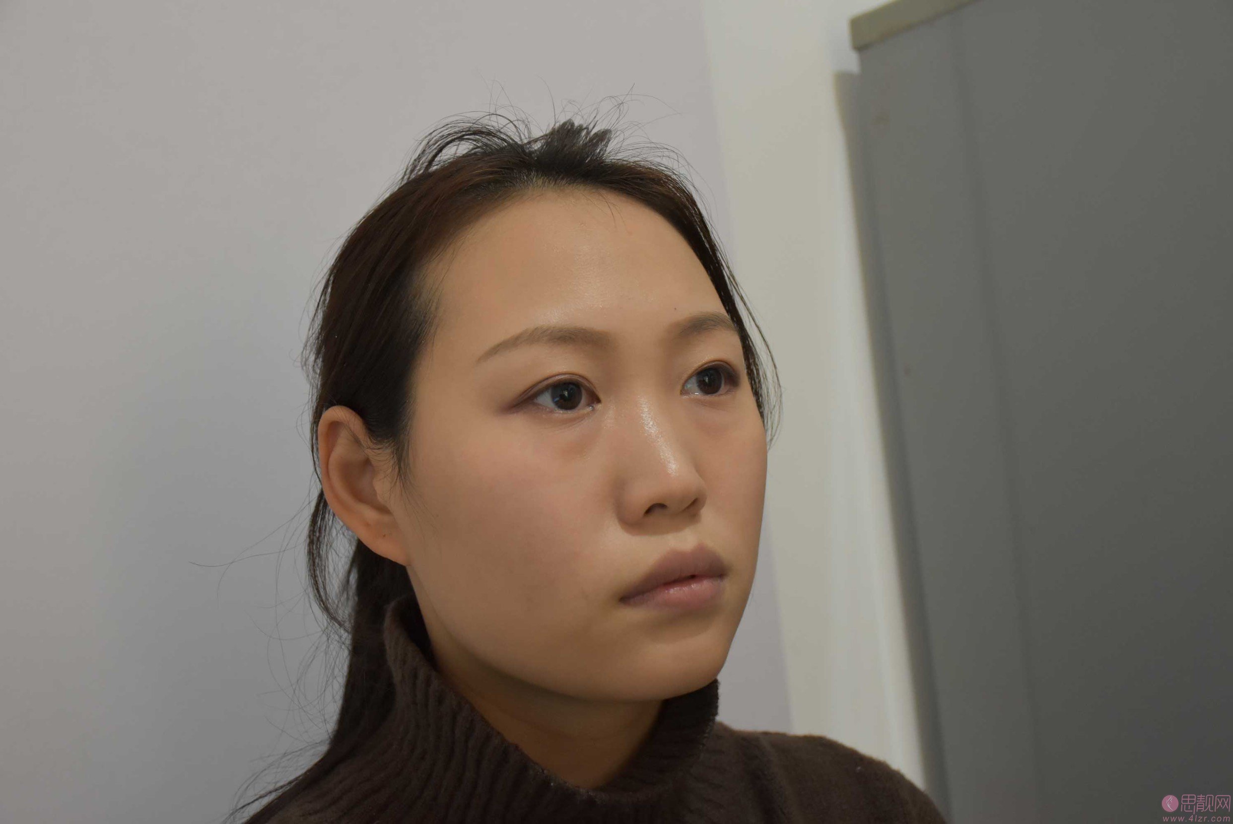 内吸去眼袋恢复期多久