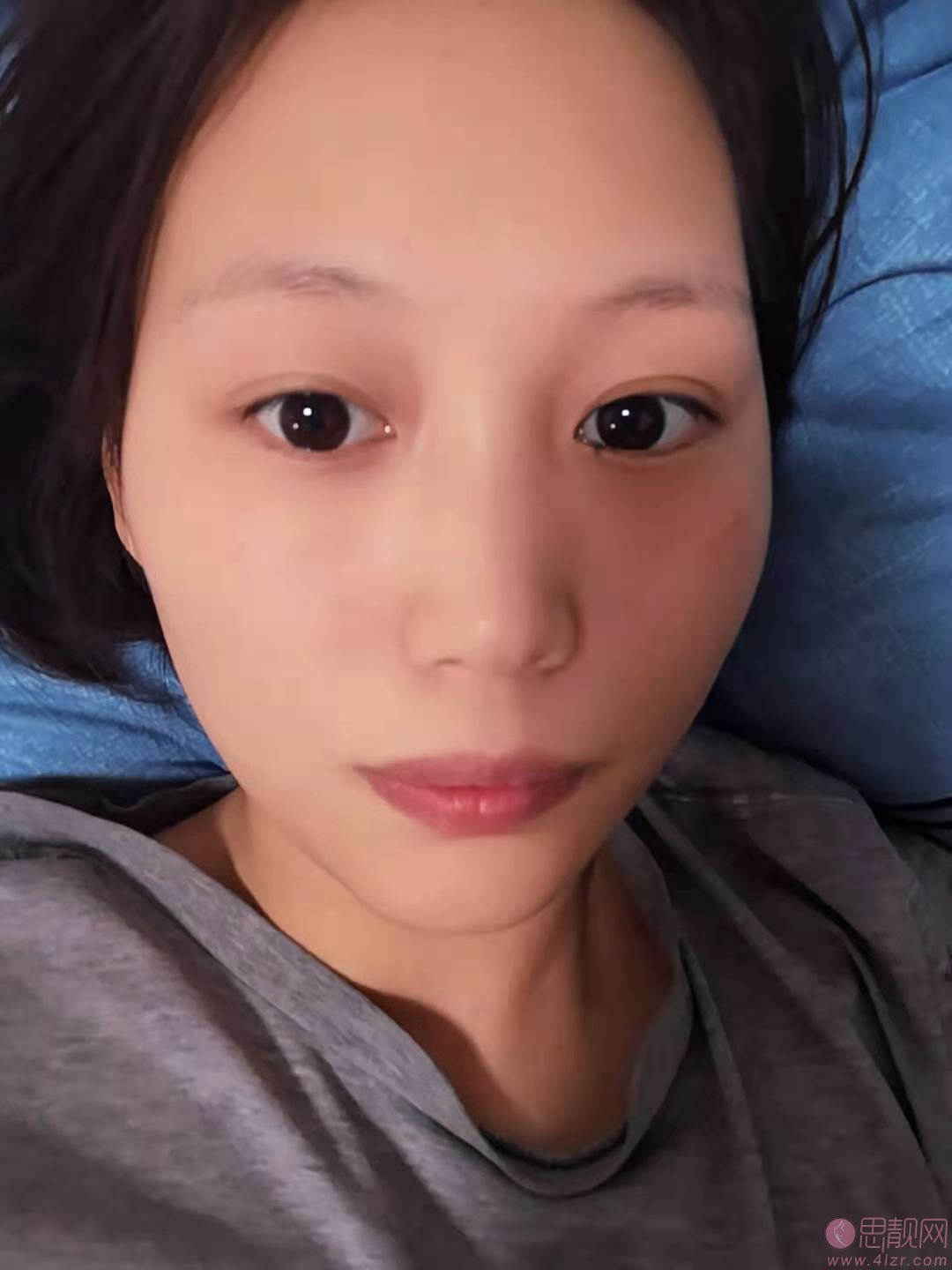 内吸去眼袋恢复期多久
