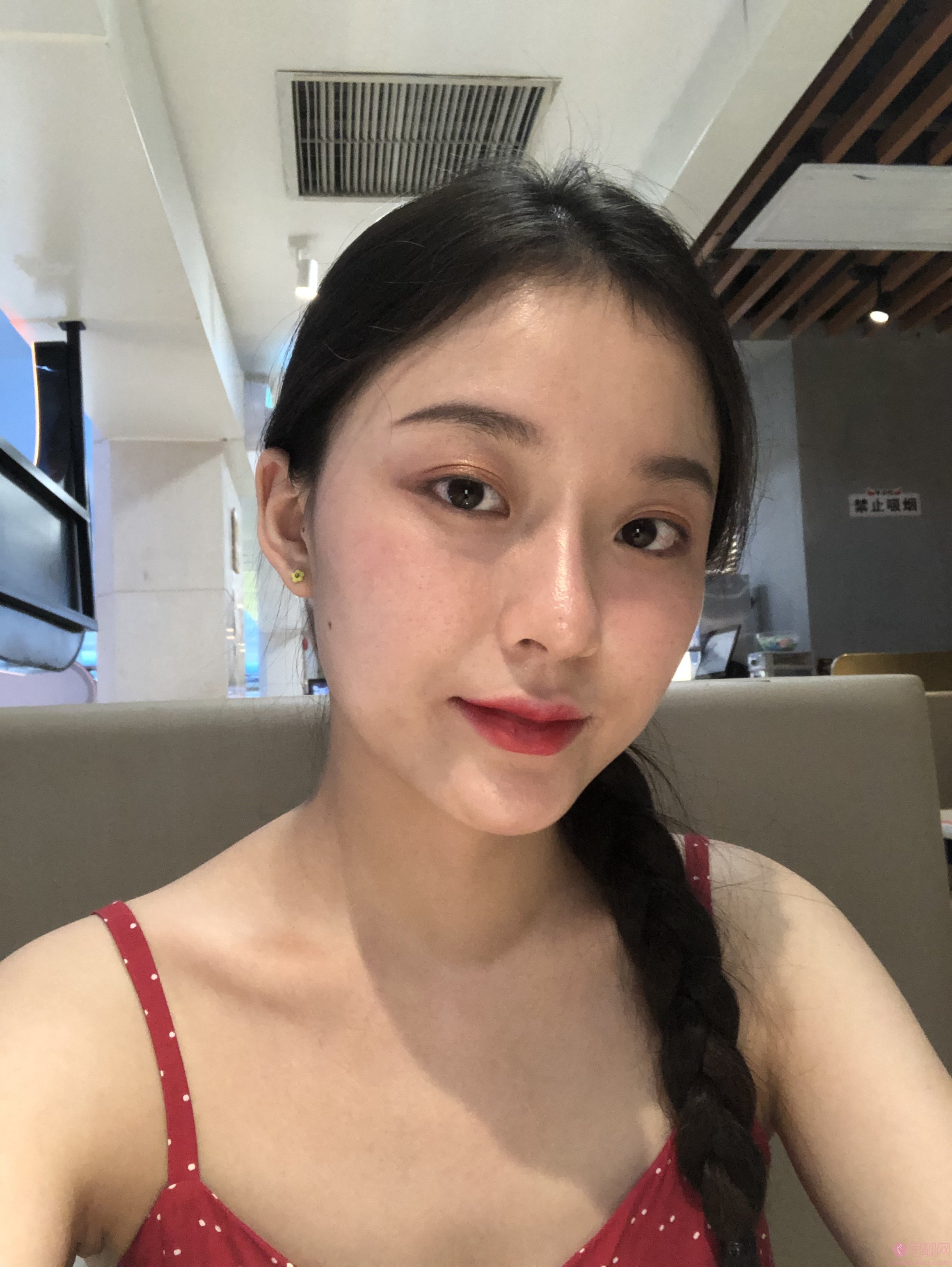 广州曙光整形医院价格表曝光+玻尿酸丰面颊真人案例分享