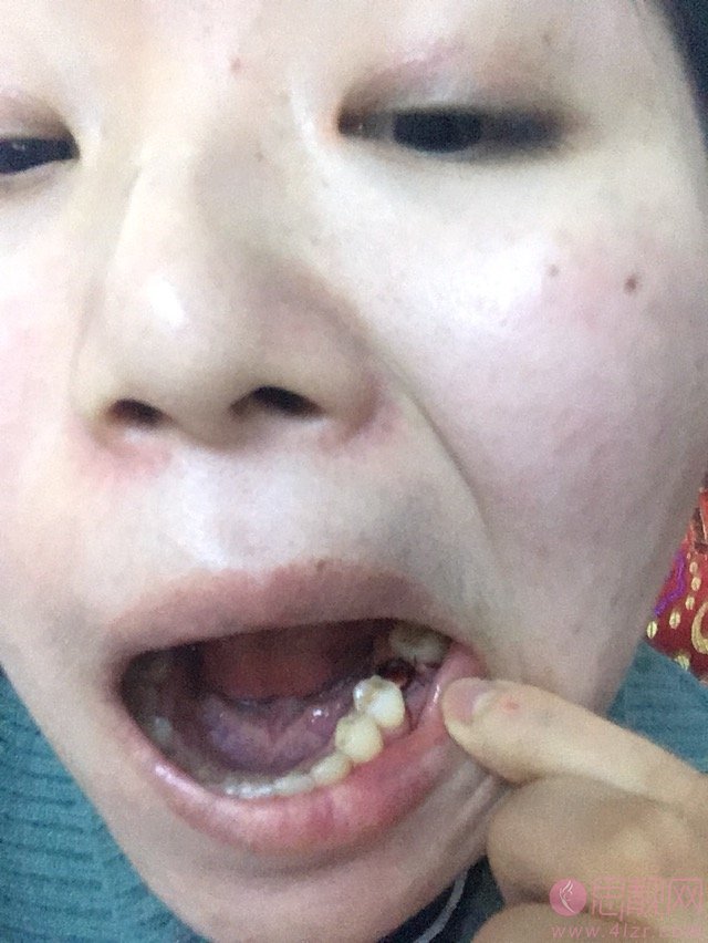 南宁柏乐口腔怎么样？靠谱吗？牙齿种植术后案例反馈