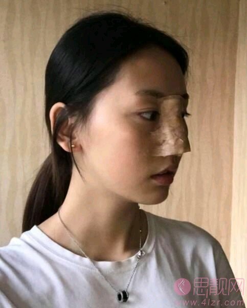 重庆联合丽格党宁隆鼻效果如何?案例分享+2021年价格表一览