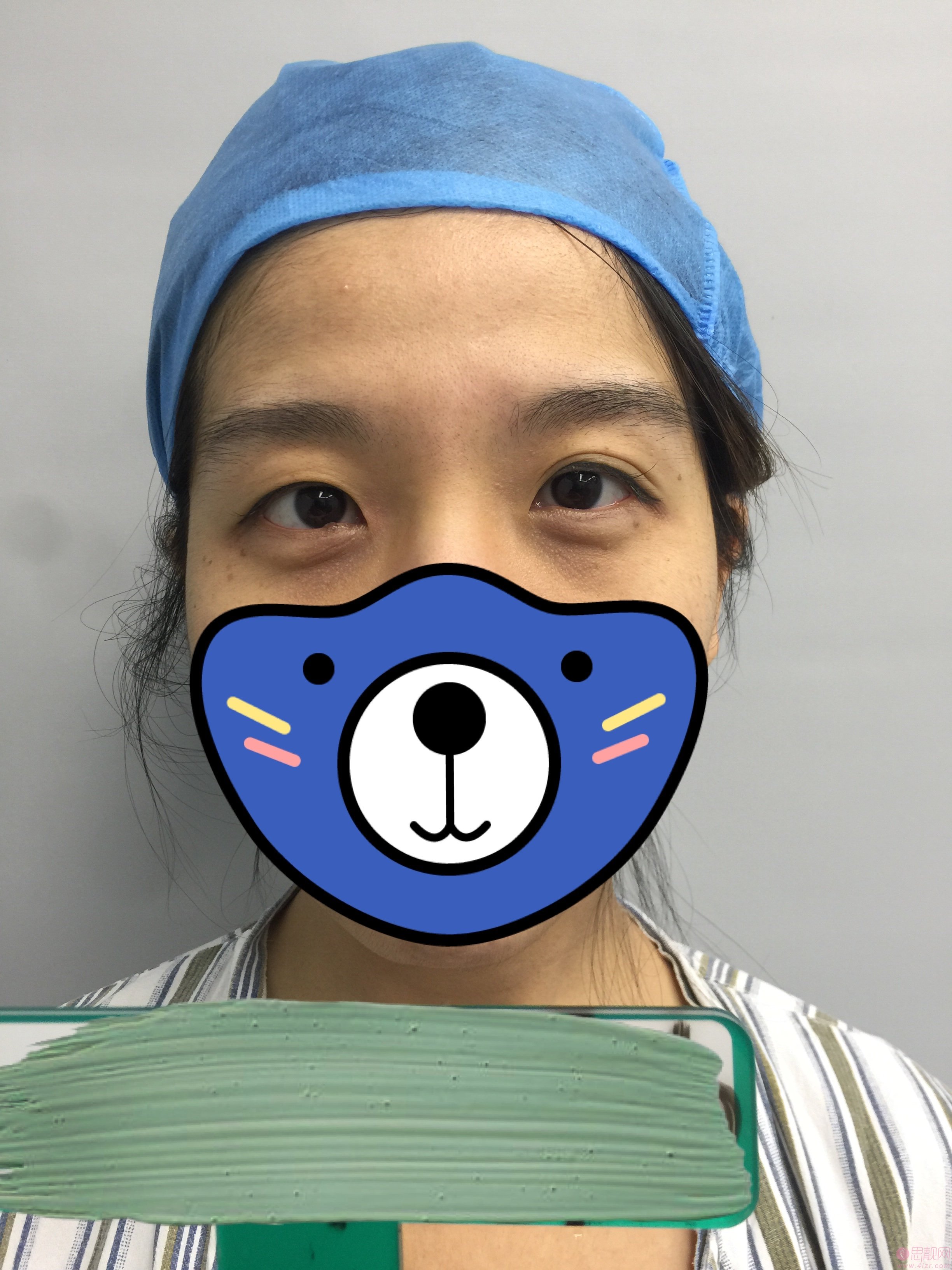 北京协和割双眼皮咋样？2021年价格表公布