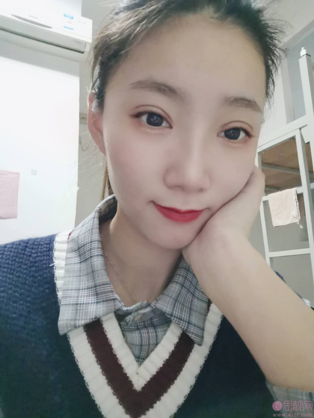上虞艺美医疗整形医院做双眼皮多少钱？附案例及2021年价格表发布