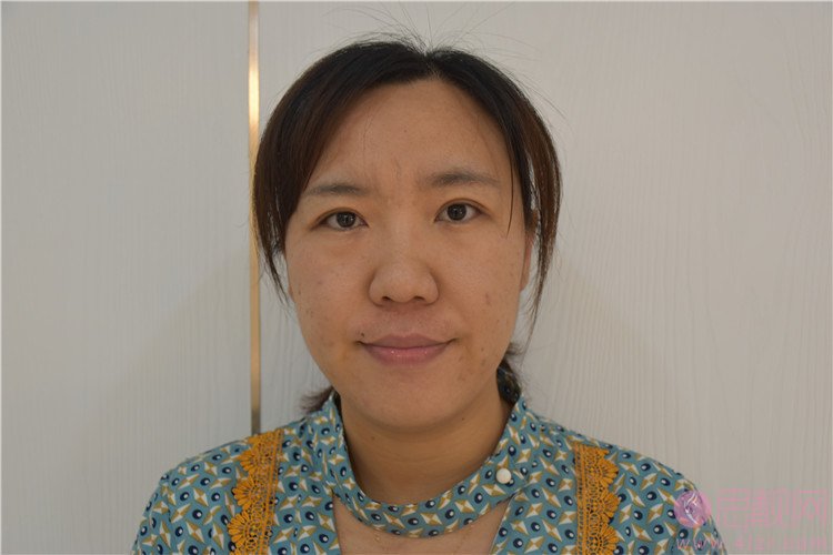 上海美诗沁去眼袋效果好吗?附祛眼袋术后案例分享+2021年价格表曝光