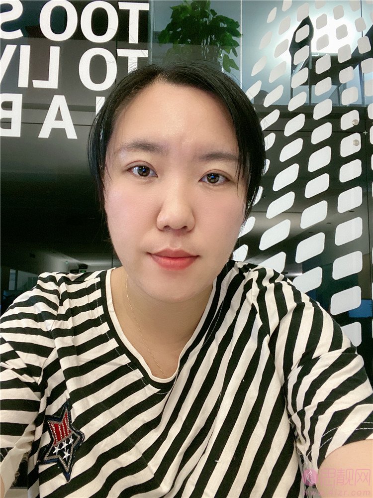 上海美诗沁去眼袋效果好吗?附祛眼袋术后案例分享+2021年价格表曝光