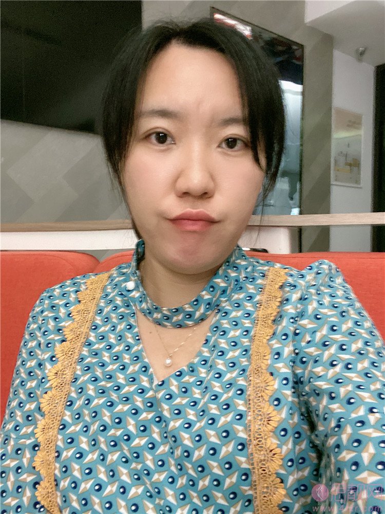 上海美诗沁去眼袋效果好吗?附祛眼袋术后案例分享+2021年价格表曝光