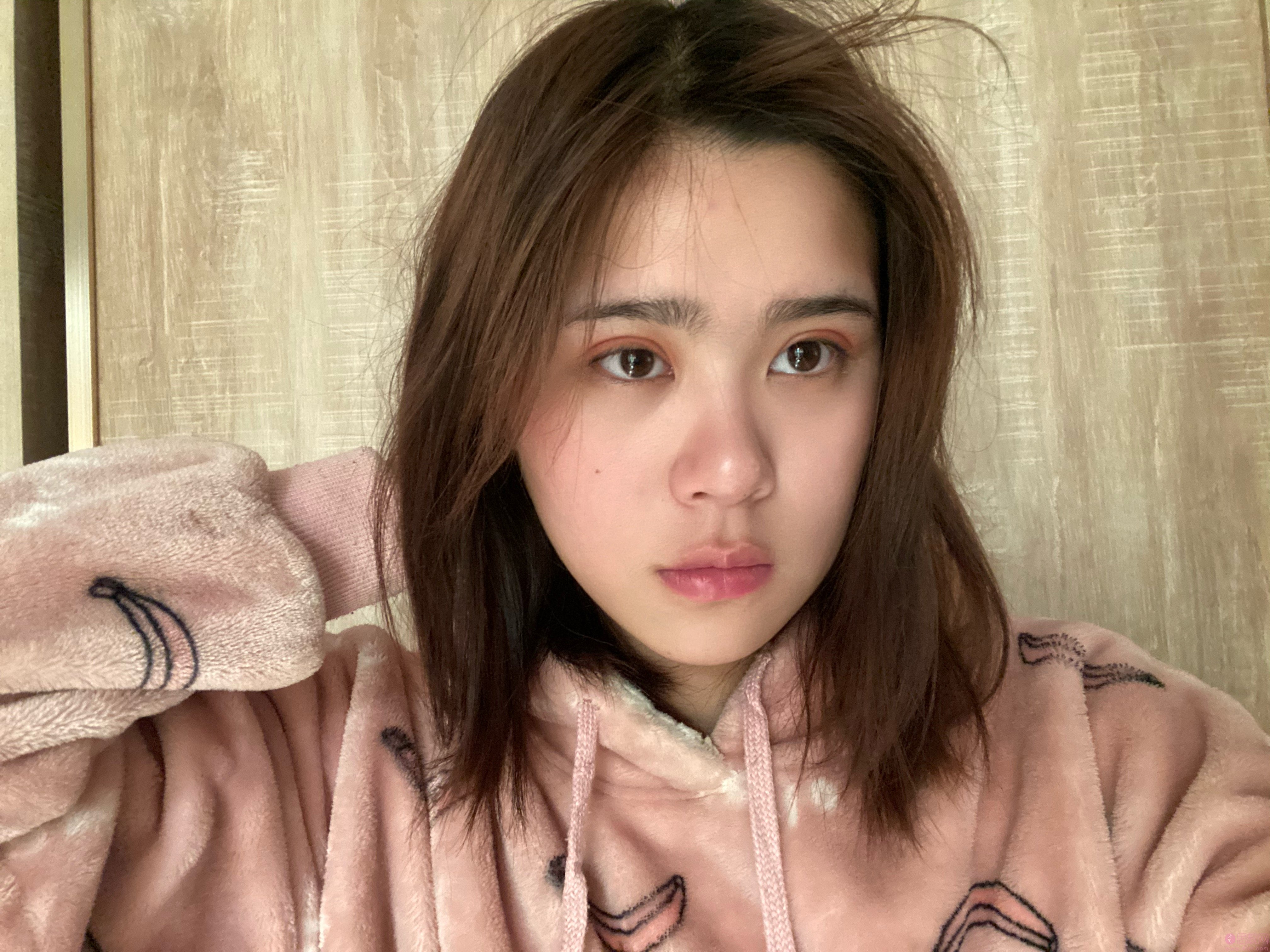 烟台华怡张苹双眼皮多少钱？附术后恢复过程图